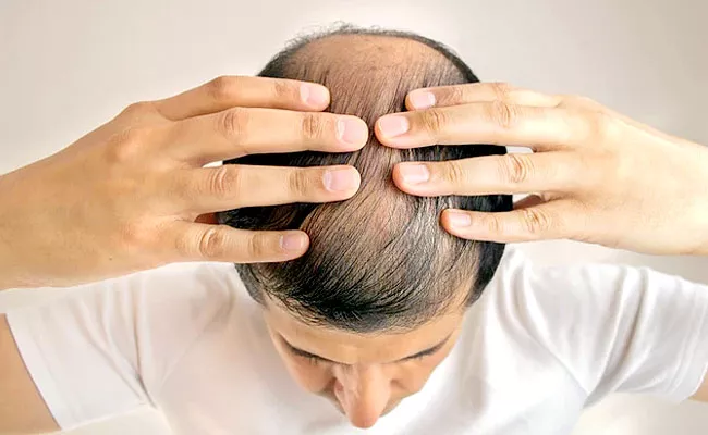 Tips For Prevention Of Hereditary Hair Fall And Baldness - Sakshi