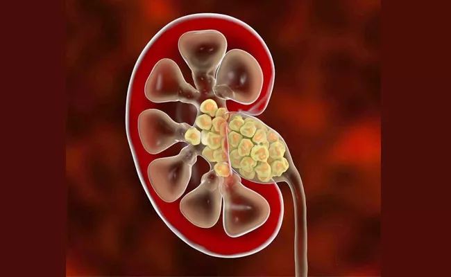 Kidney Stones Can Now be Removed Easily and Painlessly - Sakshi