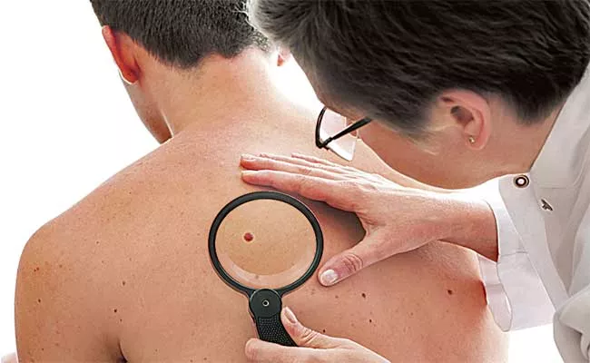 Skin Cancer Prevention Methods, Treatment - Sakshi