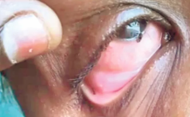 Tamilnadu: Doctors Shocked After Ants Coming Out Of Girl Eyes - Sakshi