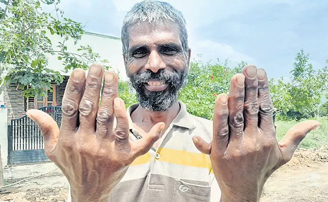 Karnataka: Man with 12 fingers and 12 Toes - Sakshi