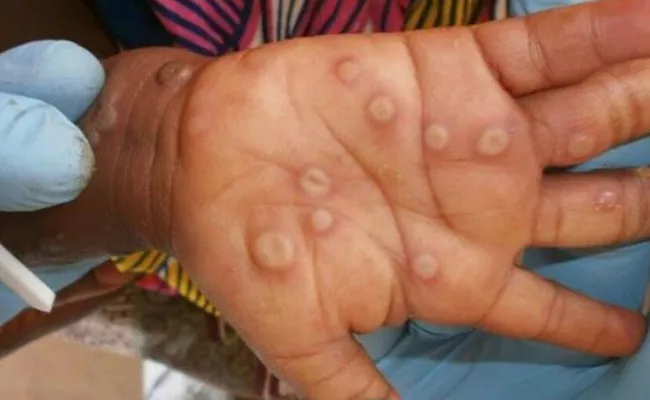 Monkeypox Khammam Suspected Referred To Hyderabad Fever Hospital - Sakshi