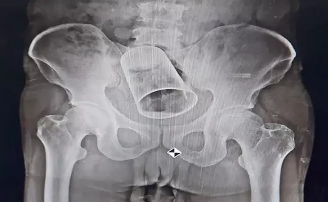 Steel Glass Inserted Mans Rectum By Drunk Friends In Odisha - Sakshi