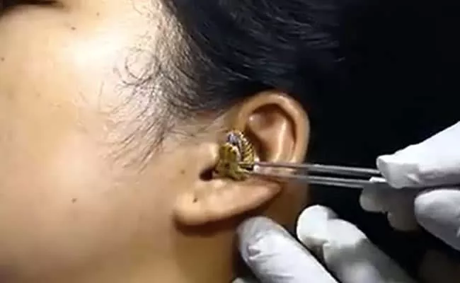 Viral Video: Doctor Numerous Attempts To Remove Snake From Ear - Sakshi