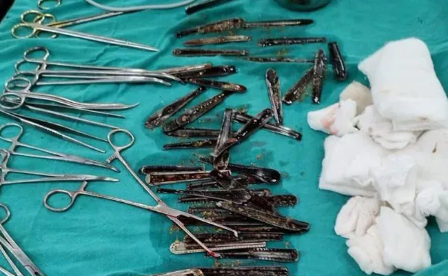 UP Doctors Found 63 Steel Spoons In The Stomach Of A Patient - Sakshi