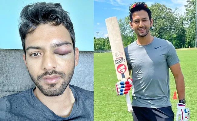 Former India U-19 Star Unmukt Chand Suffers Serious Eye Injury - Sakshi