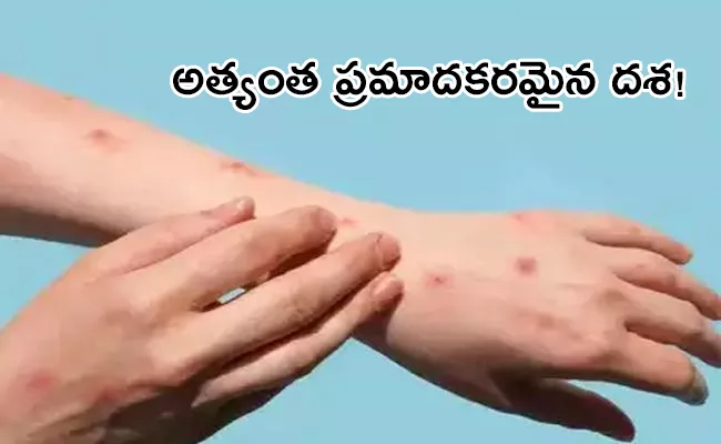 Monkeypox Cases Cross 70000 WHO Warning - Sakshi