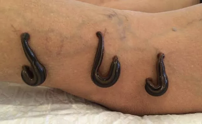 Explained: What Is Leech Therapy Its Health Benefits By Ayurvedic Expert - Sakshi