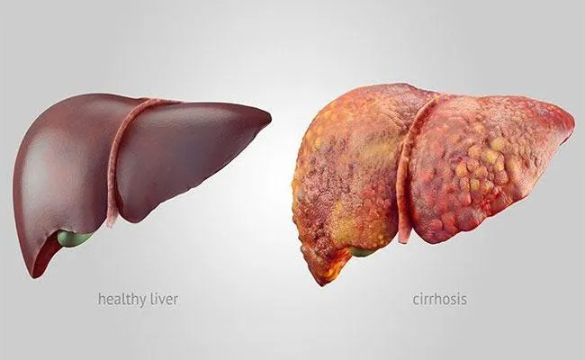 Steps For Prevention Of Liver Cirrhosis - Sakshi