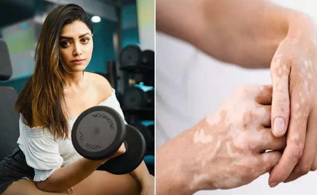 Mamta Mohandas Battle With VItiligo, Here Symptoms Of Vitiligo - Sakshi