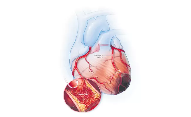 38 lakh heart disease sufferers in Andhra Pradesh - Sakshi