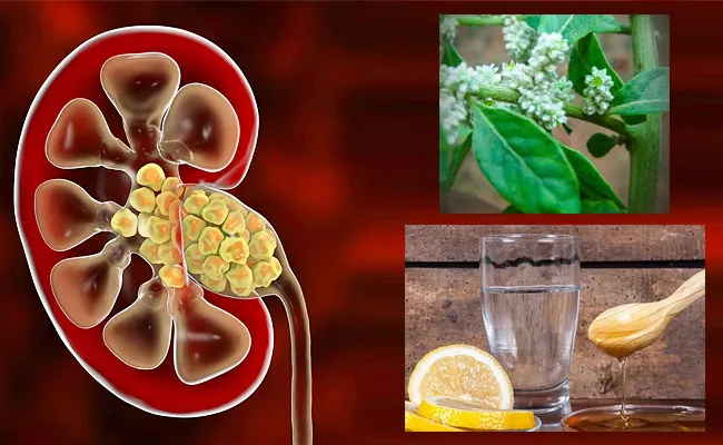 Health: Remedies For Kidney Stones What To Eat By Ayurvedic Expert - Sakshi