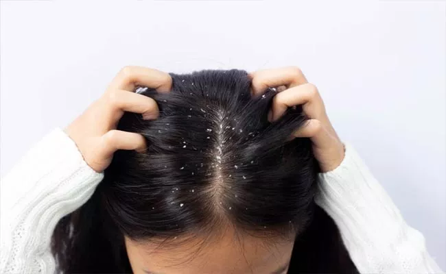 How to Prevent Dandruff In Summer east Tips - Sakshi