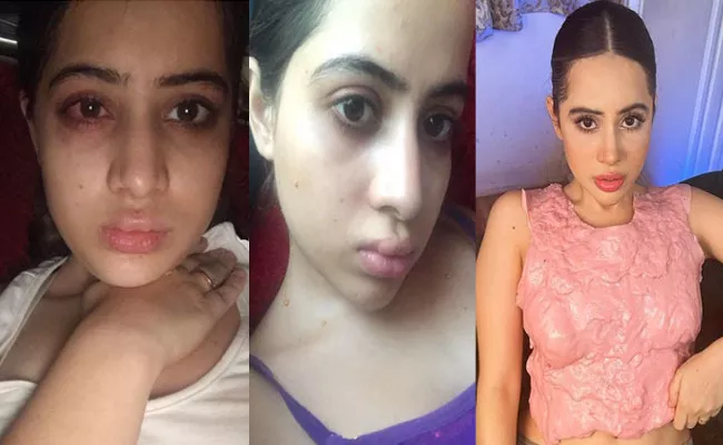 Urfi Javed Reveals About Her Failed Lips Treatment, Shocking Pics Of Her Goes Viral - Sakshi