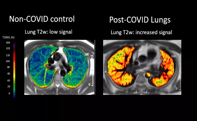 Multiorgan MRI findings after hospitalisation with COVID-19 in the UK  - Sakshi