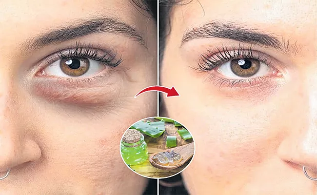 What Causes Dark Circles Under The Eyes How To Get Rid Pemanently - Sakshi