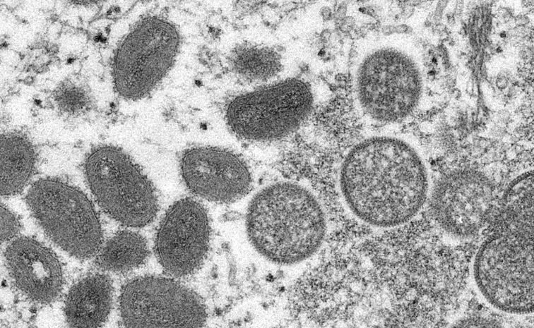 Mpox Diseased cases increasing Congo Awaits Vaccines