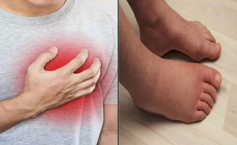 Are Swollen Feet A Sign Of Heart Failure