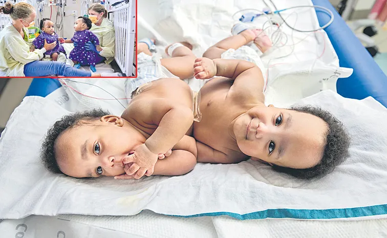 Philadelphia: Twin boys born conjoined at CHOP celebrate 1st birthday