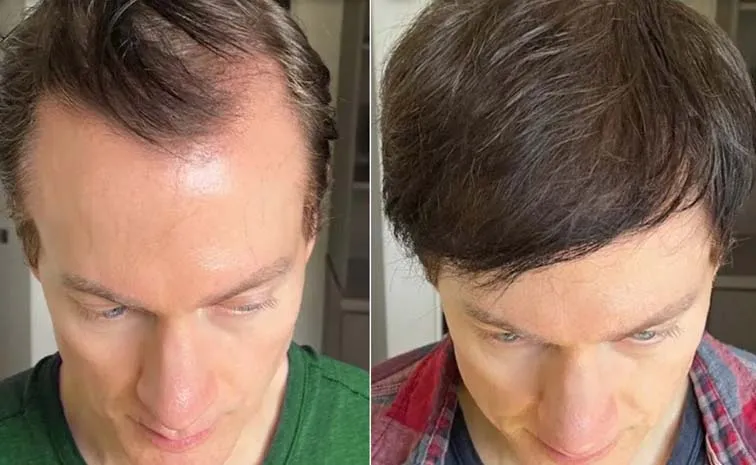 Tech Millionaire Bryan Johnson Reveals How He Reversed His Hair Loss