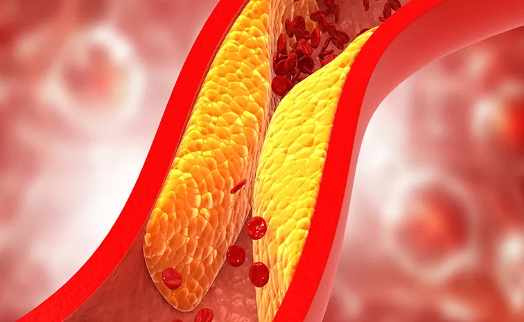 High LDL cholesterol causes silent death; check details