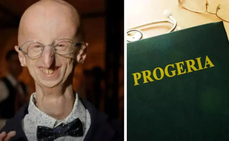 Longest Living Survivor of Progeria Dies at 28