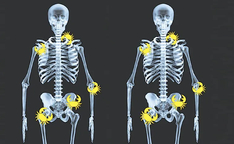 types of bone cancer