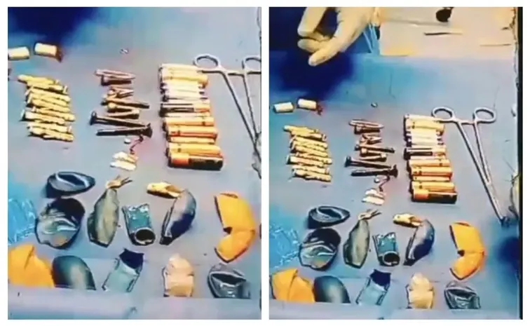 Batteries, blades among 56 metal objects removed from UP teen stomach