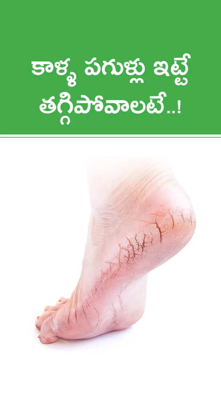 Beauty Tips: How To Heal Dry Cracked Feet Follow Simple Remedies