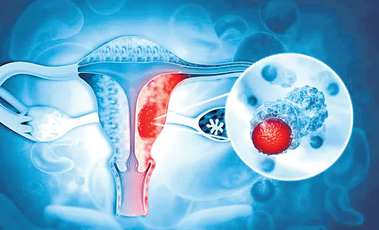 Cervical cancer - Symptoms and causes