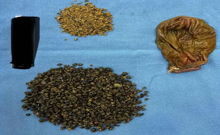 8125 Gallstones Removed from 70-Year-Old Man
