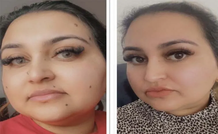 Beauty Tips: Non-Cancerous Mole Removal Beaumont Minor Surgeries