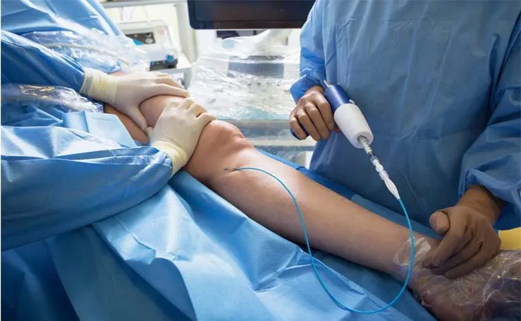 Health Tips: Sclerotherapy: Treatment for Varicose and Spider Veins